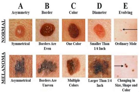 These photos show what melanoma skin cancer looks like and how to spot a cancerous mole. Researchers Developed New Technology That Can Detect Skin ...