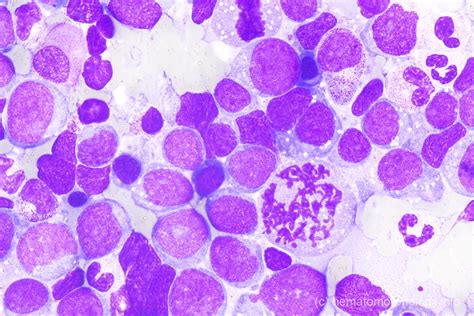 Diffuse Large B Cell Lymphoma Dlbcl Hematomorphology A Databank