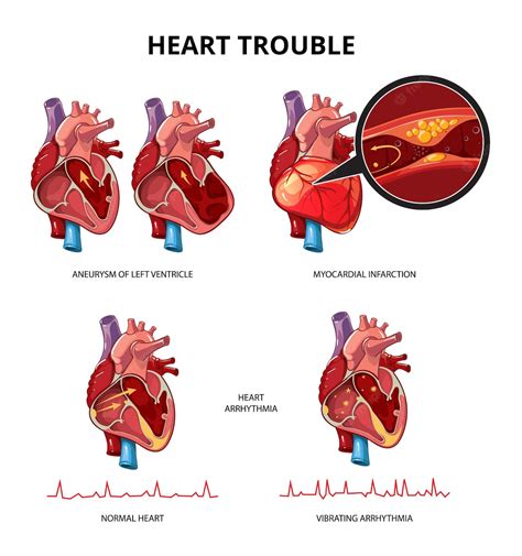 Infographie De Vecteur De Maladie Cardiaque Illustration D