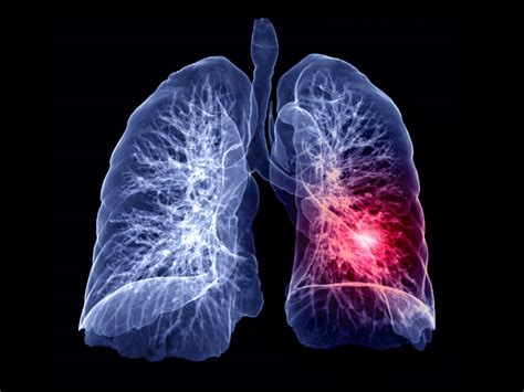 Pulmonary Embolism Is Common And Can Be Deadly But Few Know The Signs