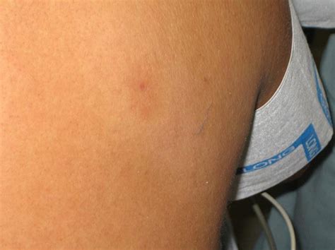 An Example Of A Black Widow Spider Bite Showing An Oval Targetlike