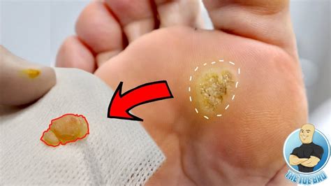 Extremely Graphic Foot Wart Removal 5 Years Of Unsuccessful