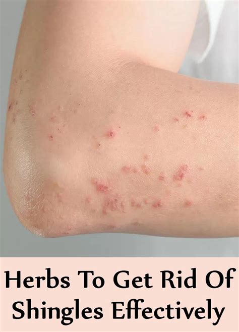 5 Herbs To Cure Shingles Effectively Natural Ways To Treat Shingles