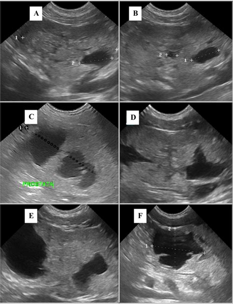Ultrasound Images Of Benign Prostatic Hyperplasia With Intraprostatic