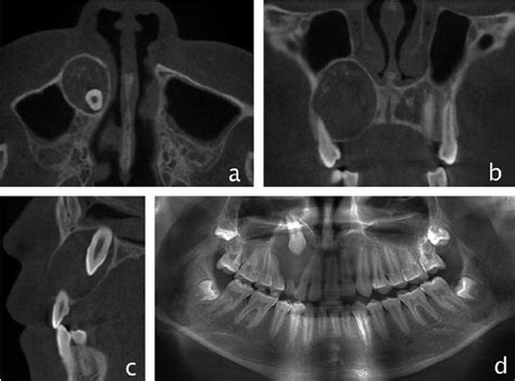 Case 2 With Different Radiopaque Patterns On Cbct And Panoramic Images