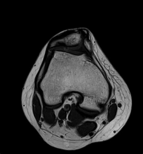 Magnetic Resonance Imaging Of The Left Knee T1 Axial Sequence Note