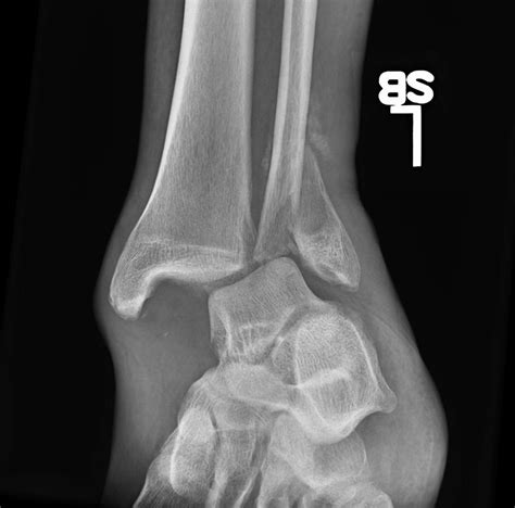 Dislocated Weber B Ankle Fracture 6 Weeks Out In A Noncompliant