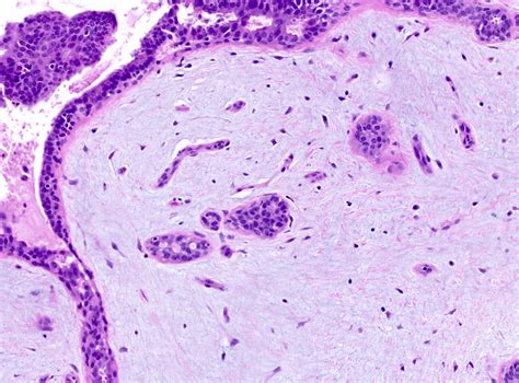 Types Fibroadenoma With Cell Changes