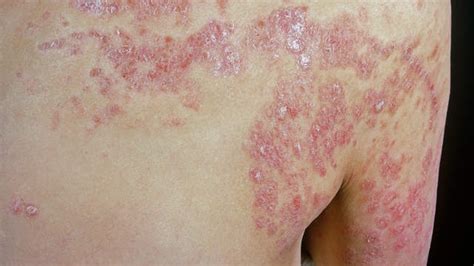 Pustular Psoriasis An Uncommon Form Of Psoriasis Consisting Of