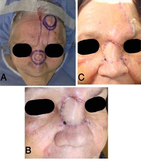 Basal Cell Carcinoma Of The Nasal Dorsum A Design Of The Island