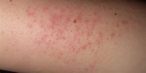 New Laser Therapy May Improve The Skin Texture Of Keratosis Pilaris 2