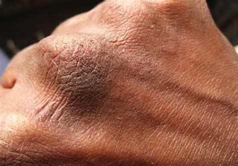 Cracked Knuckle Skin Symptoms Causes And Treatments Skincarederm