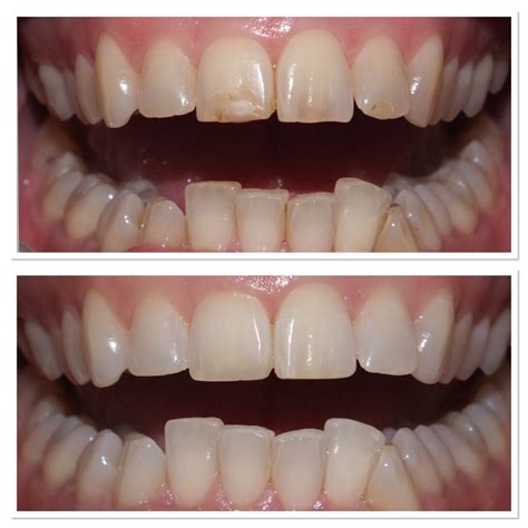 What Is Composite Bonding Scarborough Dentist And Implant Clinic