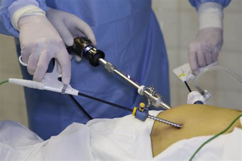 Gastric Cancer Minimally Invasive Surgery HK Surgeon
