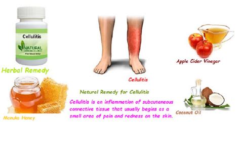 Best Natural Home Remedies To Treat Cellulitis Naturally