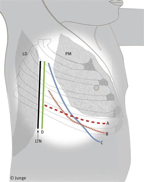 Approaches To The Thoracic Cavity Thoracic Key