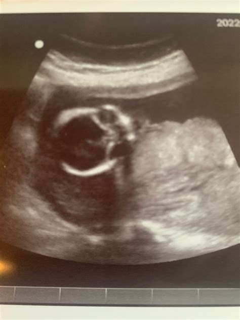 Anterior Placenta Hard To See Baby On Ultrasound Babycenter