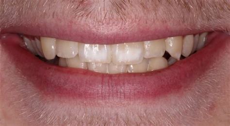 White Spots On Teeth How Do I Make Them Go Away Cranford Dental