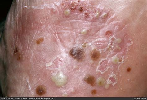 Stock Image Dermatology Pompholyx Eczema A Pustular And Peeling Rash