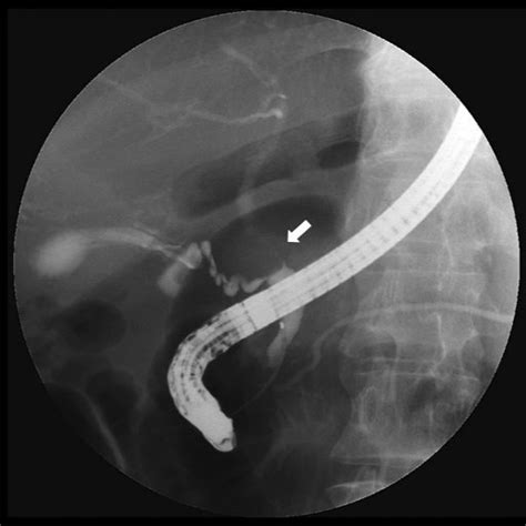 Ercp Showed A 15 Mm Long Stenosis Of The Middle Bile Duct Arrow And A