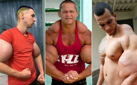 What Is Synthol And Its Side Effects — Mo Marketplace