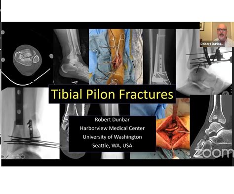 Tibial Pilon Fractures —