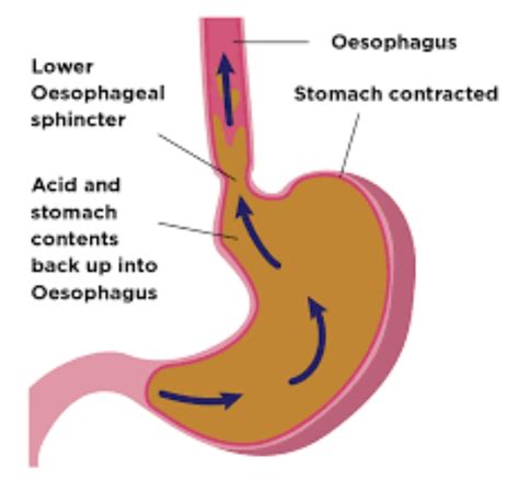 Gastroesophageal Reflux Disease Clinical Health Journal