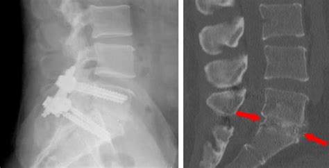 Spinal Fusion Minimally Invasive Tlif And Plif Dr Prem Pillay