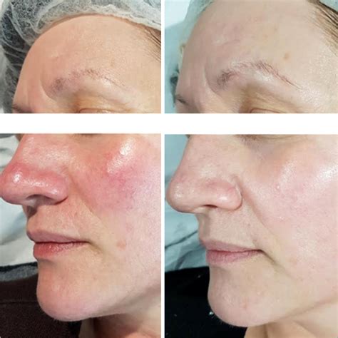 Before And After Real Results Laser Clinic Galway