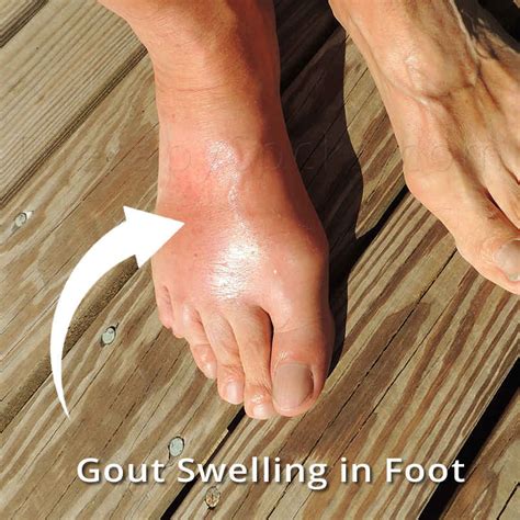 Gout In Your Feet Best Fir Socks For Treating Gout Gouty Arthritis