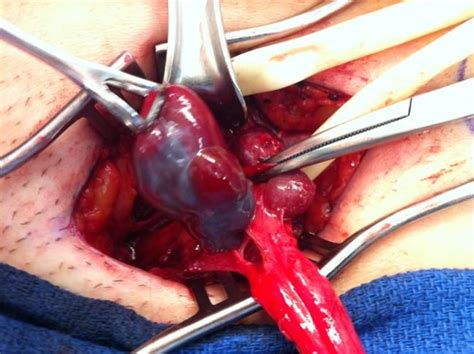 Endometriosis Within A Left Sided Inguinal Hernia Sac Food Best