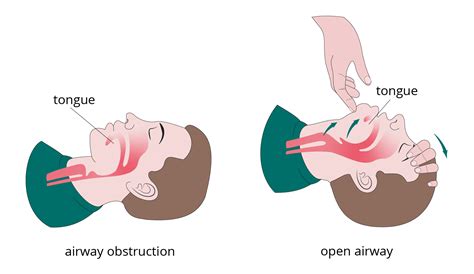Airway Management Approach To The Unresponsive Patient First Aid