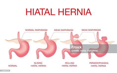 Hiatal Hernia Hiatal Hernia And Normal Anatomy Of The Stomach Stock
