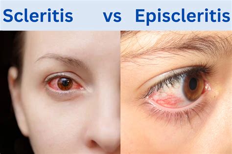 7 Powerful Tips For Managing Scleritis Episcleritis A Comprehensive