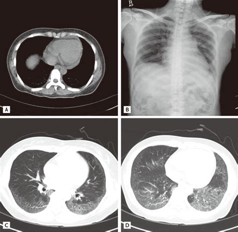 A Abdominal Computed Tomography Ct Revealed Mixed Reticular And