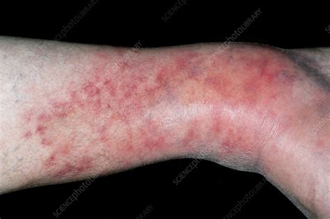 Cellulitis Of The Leg Stock Image C0111655 Science Photo Library