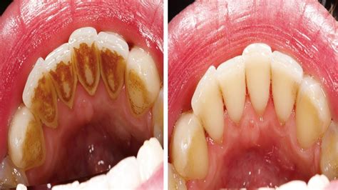 Wie man Zahnbelag entfernt ohne zum Zahnarzt gehen zu müssen Plaque