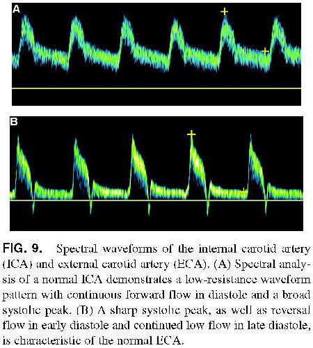 Ica And Eca Waveform External Carotid Artery Normal Doppler Waveform