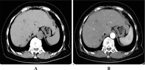 Cystic Subtype Non Enhanced Ct Scan Of The Abdomen Shows Cystic