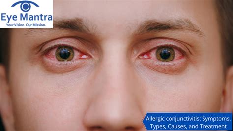 Allergic Conjunctivitis Symptoms Types Causes And Treatment
