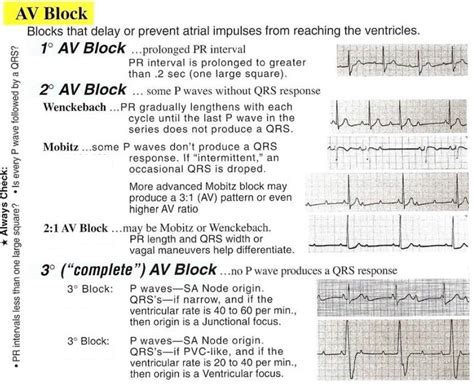 Different Types Of Heart Blocks