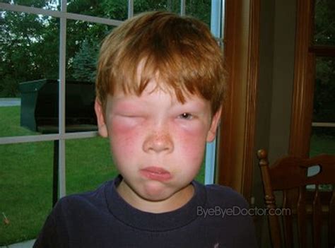 Bee Sting Swelling Remedies And Treatment
