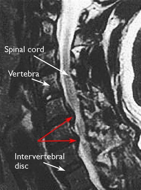 Cervical Radiculopathy Pinched Nerve Orthoinfo Aaos