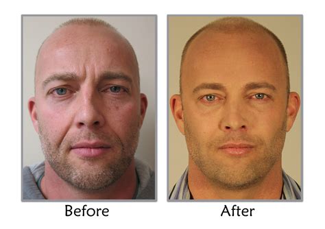 Liquid Facelift Results From The Younger You With Troy Thompson