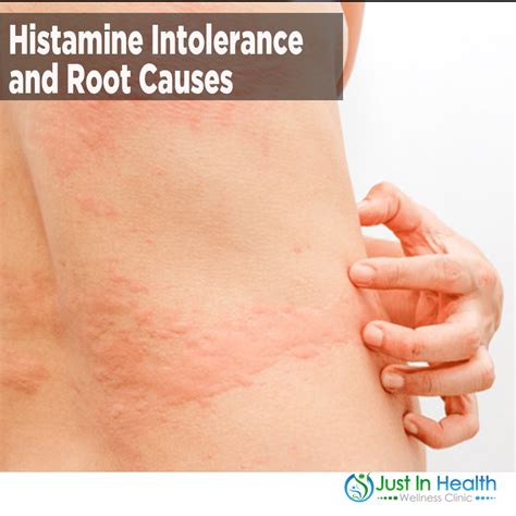 Histamine Intolerance And Root Causes Austin Texas Functional