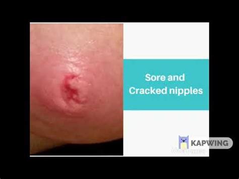Sore Cracked Nipples And Inverted Or Flat Nipples Iap Breastfeeding
