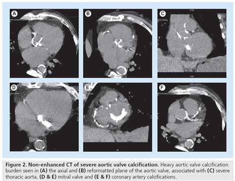Aortic Valve Calcification Using Multislice Ct