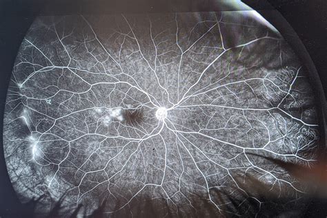 Interesting Case Of A Child Having Red Eyes Due To Subconjuctival