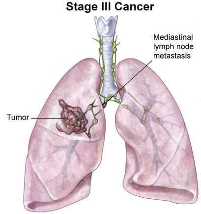 This growth can spread beyond the lung by the process of metastasis into nearby tissue or other parts of the body. Lung Cancer - Stage 3 Lung Cancer | Kimaja Farwani.