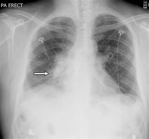 Atypical Pneumonia Definition Causes And Imaging Features